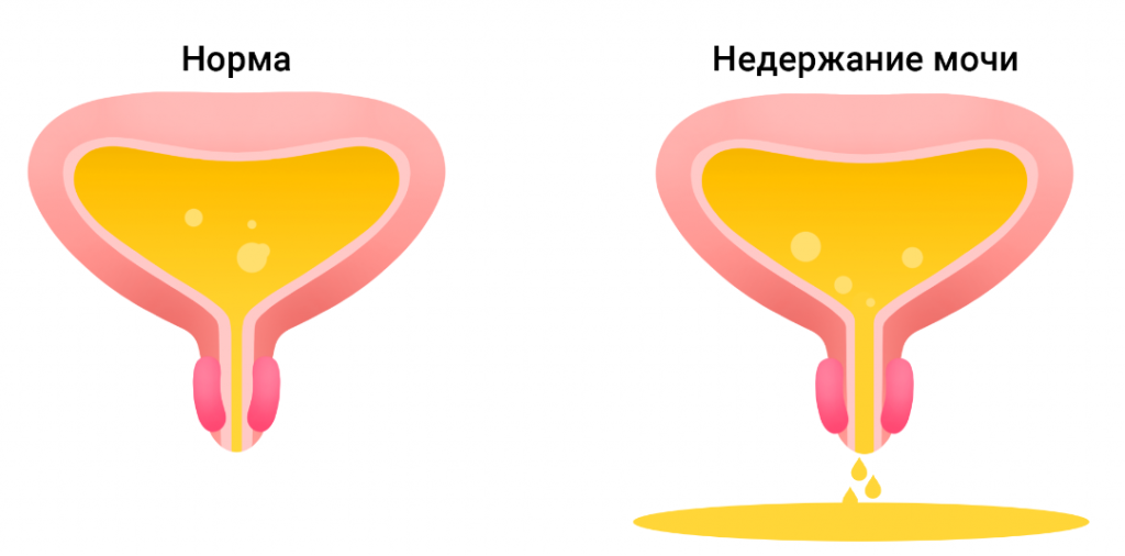 Нормальное мочеиспускание